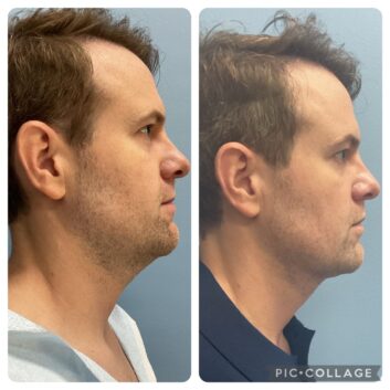 HD LIPOX™ of Jawline Specialist in Schaumburg, IL