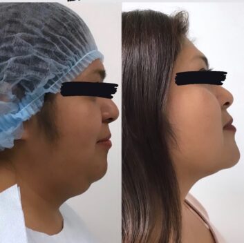HD LIPOX™ of Jawline Specialist in Schaumburg, IL