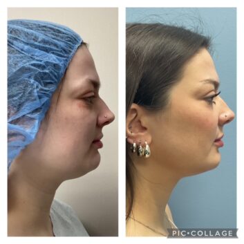 HD LIPOX™ of Jawline Specialist in Schaumburg, IL