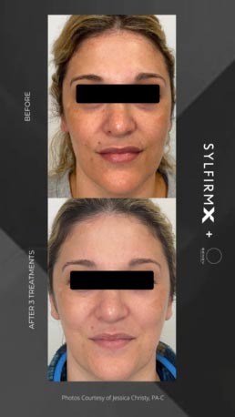Sylfirm RF Microneedling Specialist in Schaumburg, IL