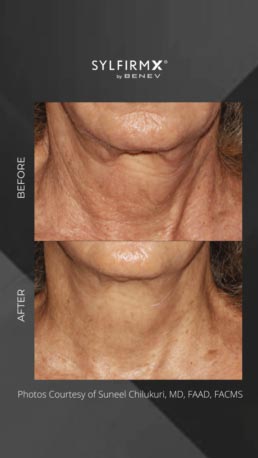 Sylfirm RF Microneedling Specialist in Schaumburg, IL