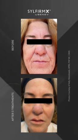 Sylfirm RF Microneedling Specialist in Schaumburg, IL