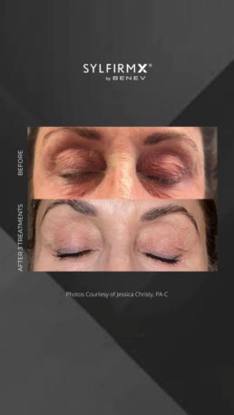 Sylfirm RF Microneedling Specialist in Schaumburg, IL