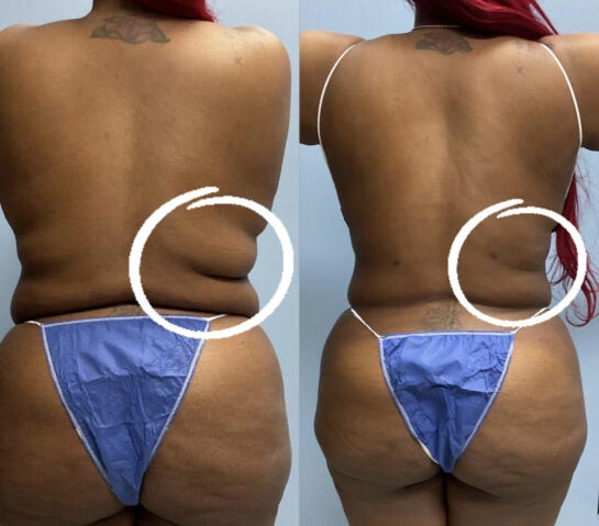 Liposuction at Face Works Plastic Surgery, Plastic Surgeon Near Me in Schaumburg, IL Liposuction at Face Works Plastic Surgery, Plastic Surgeon Near Me in Schaumburg, IL