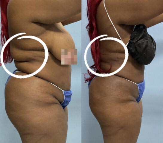 Liposuction at Face Works Plastic Surgery, Plastic Surgeon Near Me in Schaumburg, IL Liposuction at Face Works Plastic Surgery, Plastic Surgeon Near Me in Schaumburg, IL