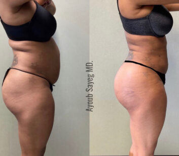 Lipo 360 Treatment at Face Works Plastic Surgery, Plastic Surgeon Near Me in Schaumburg, IL Lipo 360 Treatment at Face Works Plastic Surgery, Plastic Surgeon Near Me in Schaumburg, IL