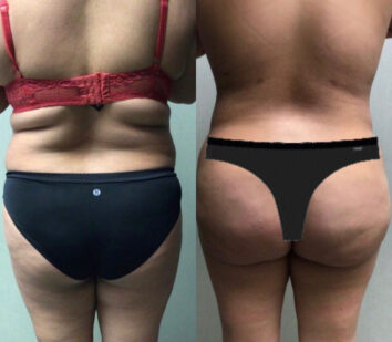 Liposuction at Face Works Plastic Surgery, Plastic Surgeon Near Me in Schaumburg, IL Liposuction at Face Works Plastic Surgery, Plastic Surgeon Near Me in Schaumburg, IL