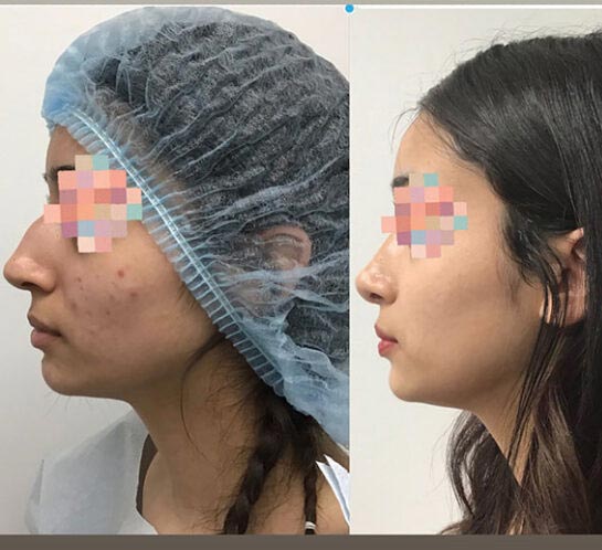 Nose Before & After Treatment Results at Face Works and Body Works Plastic Surgery