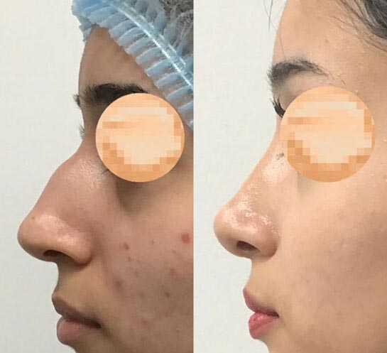 Nose Before & After Treatment Results at Face Works and Body Works Plastic Surgery