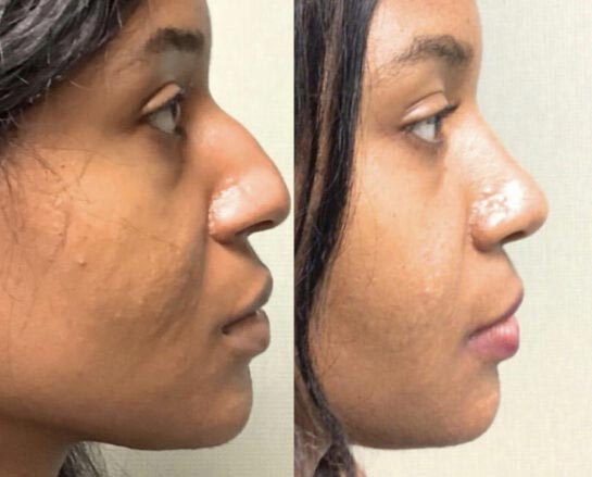 Nose Before & After Treatment Results at Face Works and Body Works Plastic Surgery