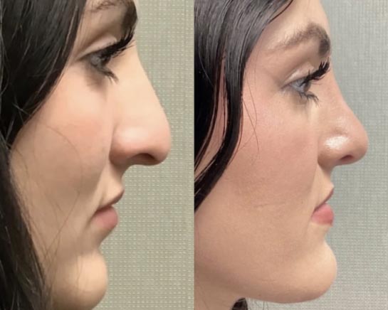 Nose Before & After Treatment Results at Face Works and Body Works Plastic Surgery