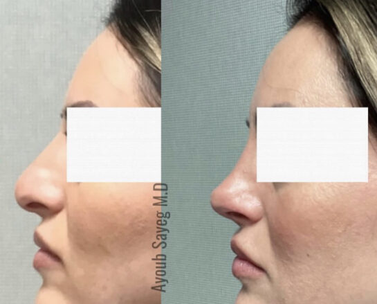 Nose Before & After Treatment Results at Face Works and Body Works Plastic Surgery
