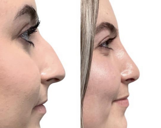 Nose Before & After Treatment Results at Face Works and Body Works Plastic Surgery