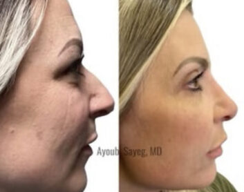 Nose Before & After Treatment Results at Face Works and Body Works Plastic Surgery