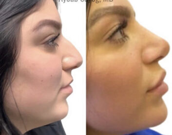 Nose Before & After Treatment Results at Face Works and Body Works Plastic Surgery