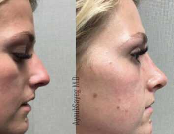 Nose Before & After Treatment Results at Face Works and Body Works Plastic Surgery