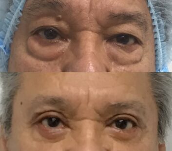 Eyelids Before & After Treatment Results at Face Works and Body Works Plastic Surgery