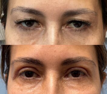 Eyelids Before & After Treatment Results at Face Works and Body Works Plastic Surgery