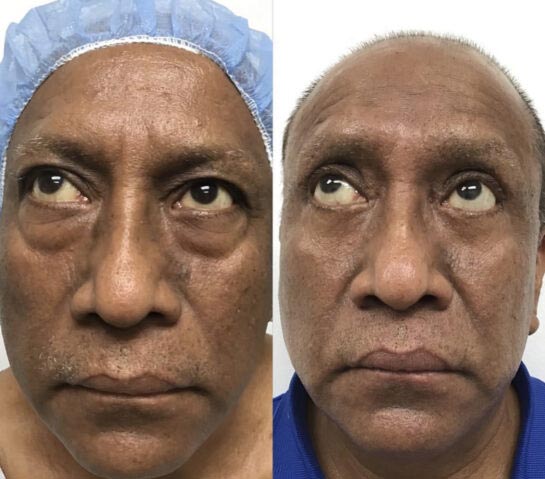Eyelids Before & After Treatment Results at Face Works and Body Works Plastic Surgery