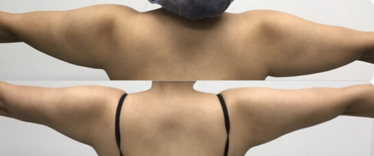 HD Arm Lipo 360 Specialist Serving Chicago, Schaumburg, IL