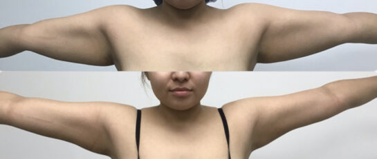 HD Arm Lipo 360 Specialist Serving Chicago, Schaumburg, IL