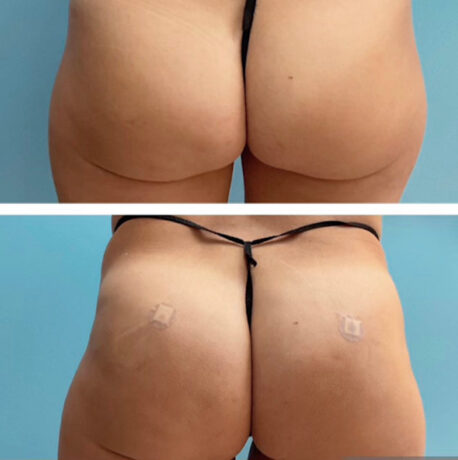 Brazilian Butt Lift (Fat Transfer or Liquid) Before & After Results at Face Works and Body Work Plastic Surgery