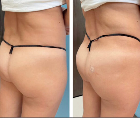 Brazilian Butt Lift (Fat Transfer or Liquid) Before & After Results at Face Works and Body Work Plastic Surgery