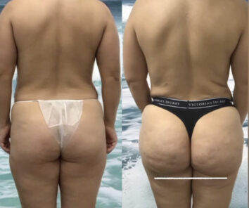 Brazilian Butt Lift (Fat Transfer or Liquid) Before & After Results at Face Works and Body Work Plastic Surgery