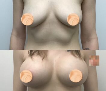 Breast Augmentation - Lift Before & After Results at Face Works and Body Work Plastic Surgery