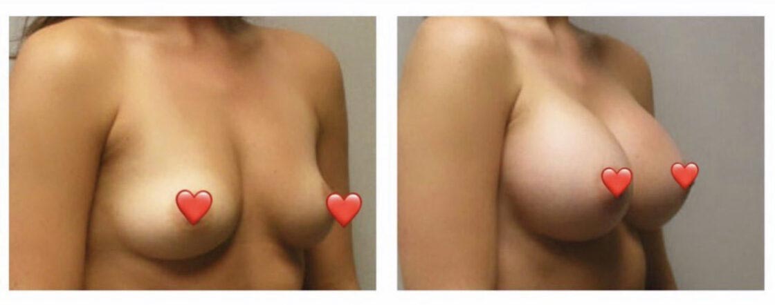 Breast Augmentation - Lift Before & After Results at Face Works and Body Work Plastic Surgery