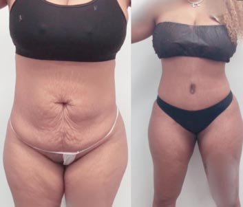 Tummy Tuck Before & After Treatment Results at Face Works and Body Works Plastic Surgery