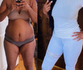 Tummy Tuck Before & After Treatment Results at Face Works and Body Works Plastic Surgery