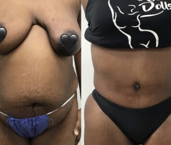 Tummy Tuck Before & After Treatment Results at Face Works and Body Works Plastic Surgery