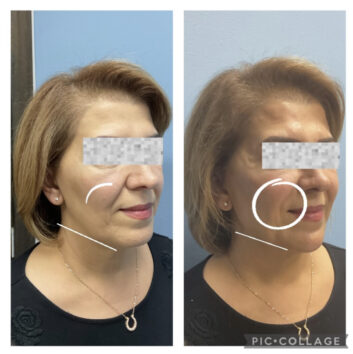 Dermal Fillers (Face, Lips, Chin, Jaw) Before & After Treatment Results at Face Works and Body Works Plastic Surgery
