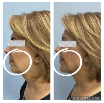 Dermal Fillers (Face, Lips, Chin, Jaw) Before & After Treatment Results at Face Works and Body Works Plastic Surgery