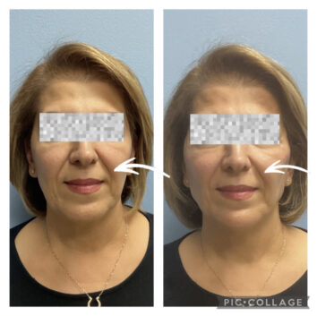 Dermal Fillers (Face, Lips, Chin, Jaw) Before & After Treatment Results at Face Works and Body Works Plastic Surgery