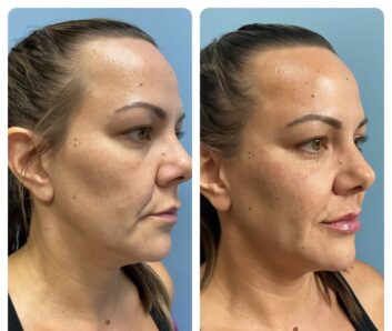Dermal Fillers (Face, Lips, Chin, Jaw) Before & After Treatment Results at Face Works and Body Works Plastic Surgery