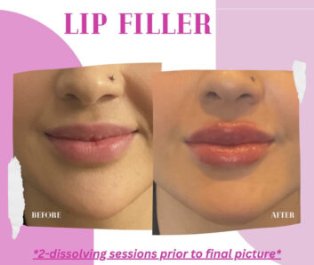 Dermal Fillers (Face, Lips, Chin, Jaw) Before & After Treatment Results at Face Works and Body Works Plastic Surgery