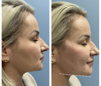 Dermal Fillers (Face, Lips, Chin, Jaw) Before & After Treatment Results at Face Works and Body Works Plastic Surgery
