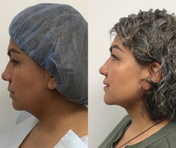Dermal Fillers (Face, Lips, Chin, Jaw) Before & After Treatment Results at Face Works and Body Works Plastic Surgery