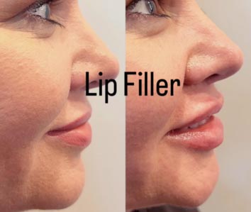 Dermal Fillers (Face, Lips, Chin, Jaw) Before & After Treatment Results at Face Works and Body Works Plastic Surgery