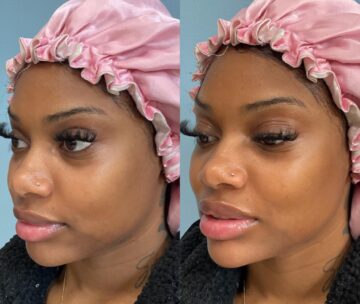 Dermal Fillers (Face, Lips, Chin, Jaw) Before & After Treatment Results at Face Works and Body Works Plastic Surgery