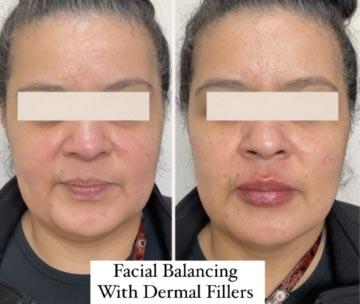 Dermal Fillers (Face, Lips, Chin, Jaw) Before & After Treatment Results at Face Works and Body Works Plastic Surgery