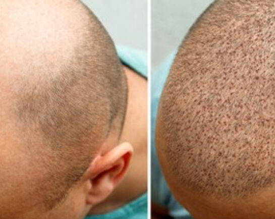 Hair Transplant/Restoration (Exosome or PRP) Before & After Results at Face Works and Body Works Plastic Surgery