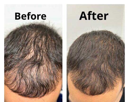 Hair Transplant/Restoration (Exosome or PRP) Before & After Results at Face Works and Body Works Plastic Surgery