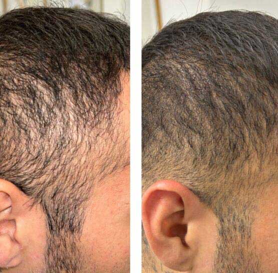 Hair Transplant/Restoration (Exosome or PRP) Before & After Results at Face Works and Body Works Plastic Surgery