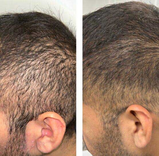 Hair Transplant/Restoration (Exosome or PRP) Before & After Results at Face Works and Body Works Plastic Surgery