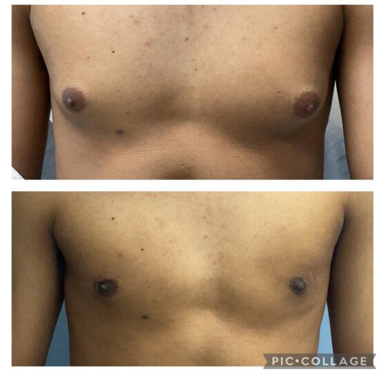 Gynecomastia Before & After Treatment Results at Face Works and Body Works Plastic Surgery