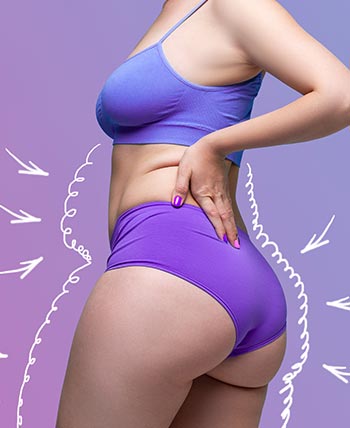 Cellulite Treatment in Schaumburg, IL and Chicago, IL Cellulite Treatment in Schaumburg, IL and Chicago, IL