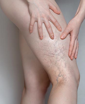 Spider Veins (Sclerotherapy) in Schaumburg, IL and Chicago, IL Spider Veins (Sclerotherapy) in Schaumburg, IL and Chicago, IL